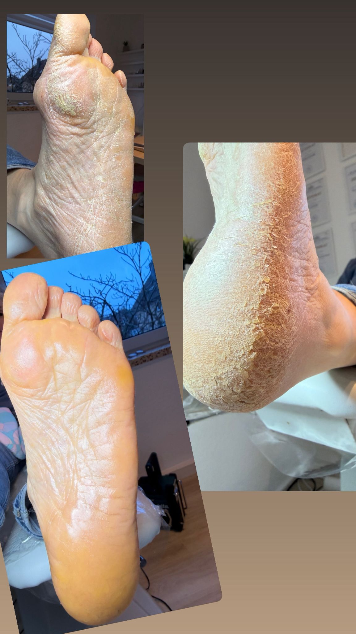 Fußpflege Galerie - Pflegesergebnis