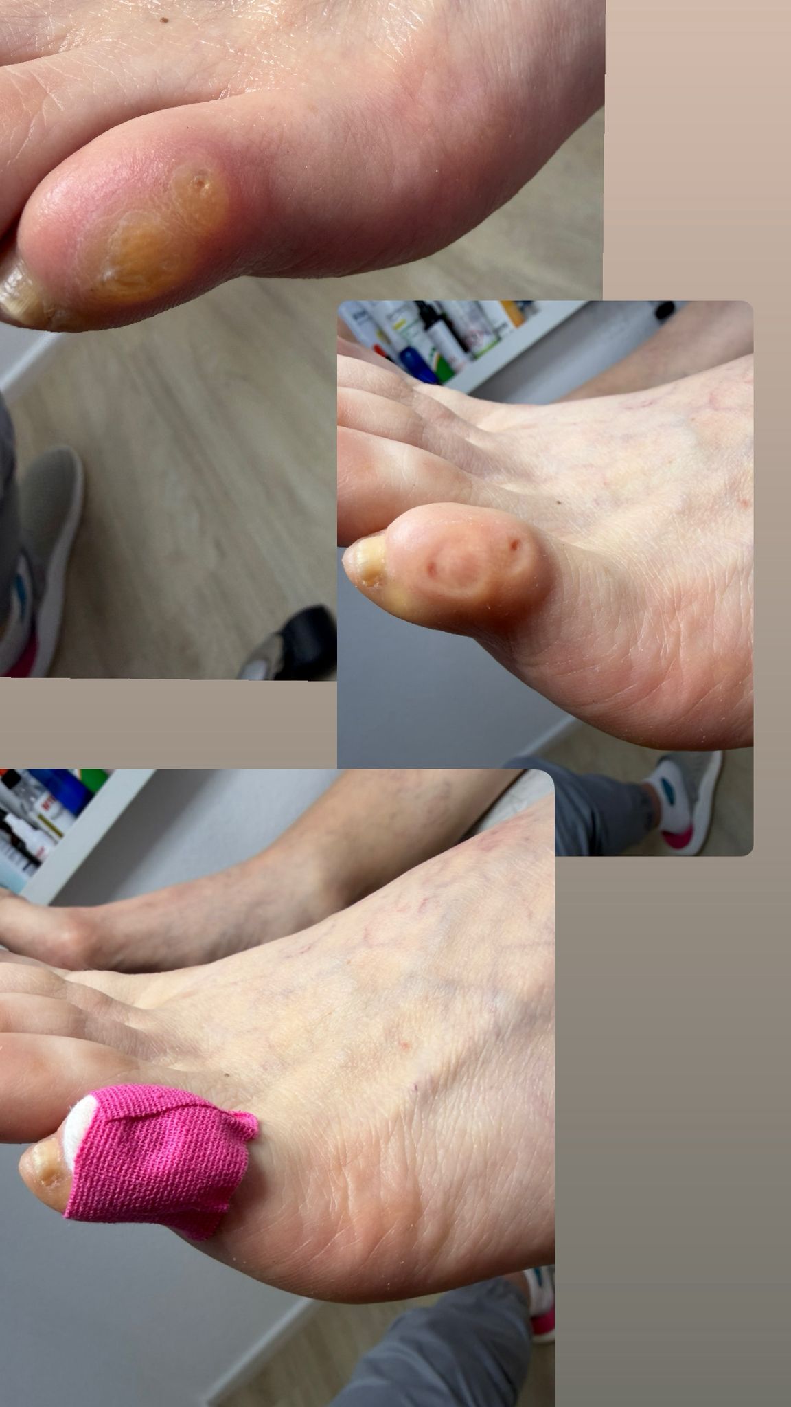 Professionelle Fußpflege - Vorher-Nachher